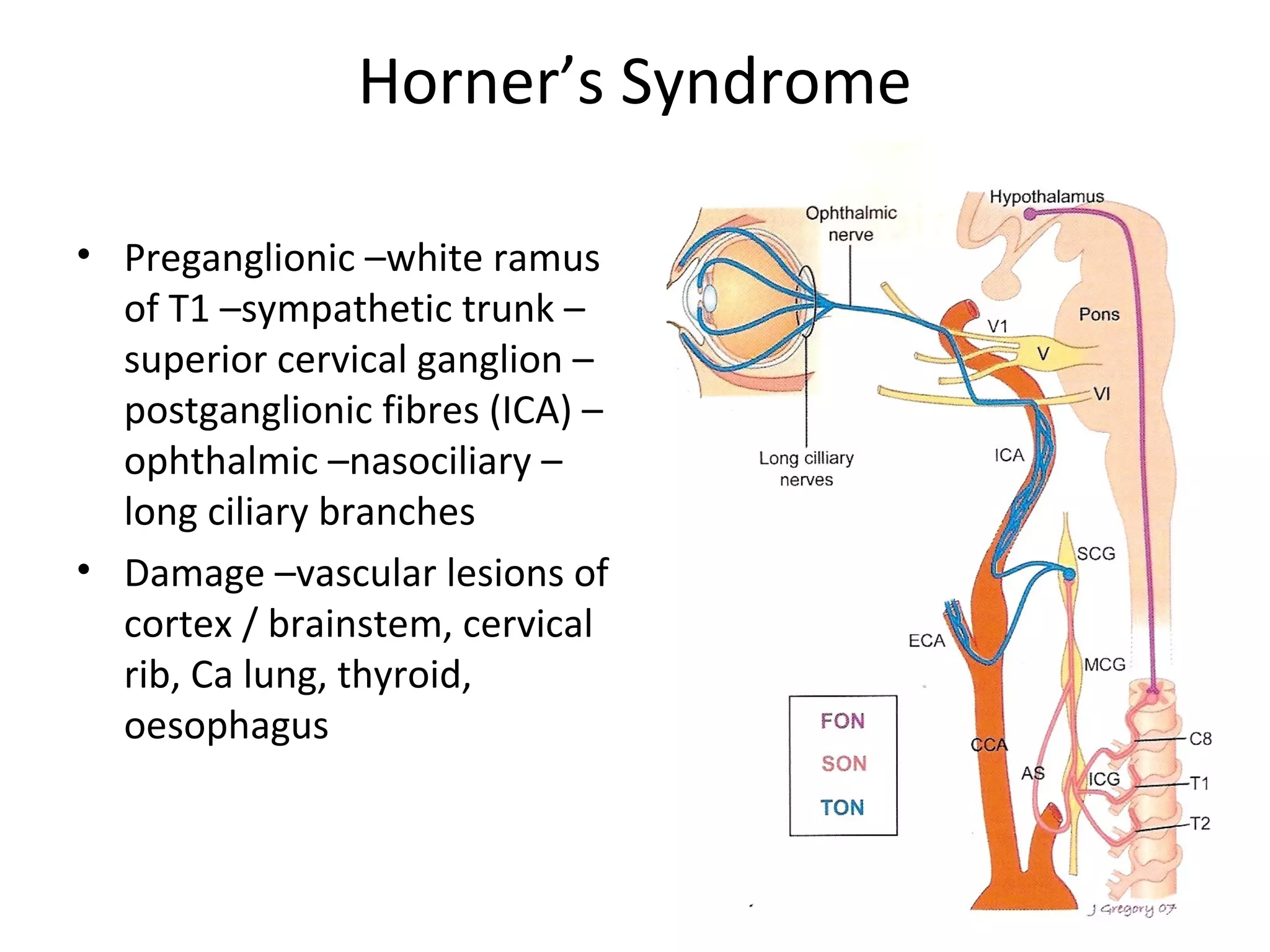 42
Horner’s Syndrome
• Preganglionic –white ramus
of T1 –sympathetic trunk –
superior cervical ganglion –
postganglionic fibres (ICA) –
ophthalmic –nasociliary –
long ciliary branches
• Damage –vascular lesions of
cortex / brainstem, cervical
rib, Ca lung, thyroid,
oesophagus
 