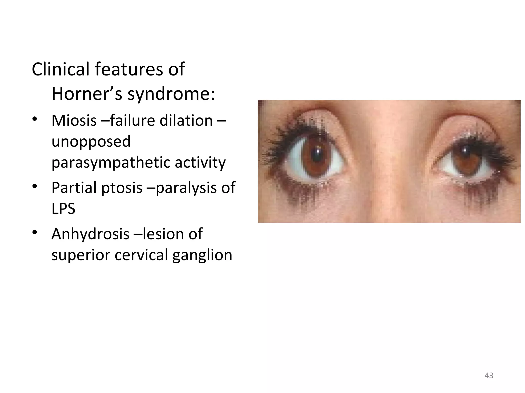 43
Clinical features of
Horner’s syndrome:
• Miosis –failure dilation –
unopposed
parasympathetic activity
• Partial ptosis –paralysis of
LPS
• Anhydrosis –lesion of
superior cervical ganglion
 