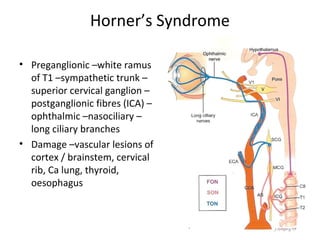 Horner’s Syndrome

• Preganglionic –white ramus
  of T1 –sympathetic trunk –
  superior cervical ganglion –
  postganglionic fibres (ICA) –
  ophthalmic –nasociliary –
  long ciliary branches
• Damage –vascular lesions of
  cortex / brainstem, cervical
  rib, Ca lung, thyroid,
  oesophagus



                                    42
 