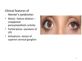 Clinical features of
   Horner’s syndrome:
• Miosis –failure dilation –
  unopposed
  parasympathetic activity
• Partial p...