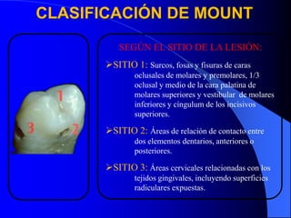 CLASIFICACIÓN DE MOUNT
SEGÚN EL SITIO DE LA LESIÓN:
SITIO 1: Surcos, fosas y fisuras de caras
oclusales de molares y premolares, 1/3
oclusal y medio de la cara palatina de
molares superiores y vestibular de molares
inferiores y cíngulum de los incisivos
superiores..

SITIO 2: Áreas de relación de contacto entre
dos elementos dentarios, anteriores o
posteriores.

SITIO 3: Áreas cervicales relacionadas con los
tejidos gingivales, incluyendo superficies
radiculares expuestas.

 