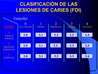 CLASIFICACIÓN DE LAS
LESIONES DE CARIES (FDI)
TAMAÑO
0
SITIO
1
FOSAS Y
FISURAS

2
ÁREAS DE
CONTACTO

3
CERVICAL

1

2

3

4

NO CAVITADO

MÍNIMA

MODERADA

GRANDE

EXTENSA

1.O
1.0

1.1

1.2

1.3

1.4

2.0

2.1

2.2

2.3

2.4

3.0

3.1

3.2

3.3

3.4

 