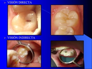 

VISIÓN DIRECTA



VISIÓN INDIRECTA

 