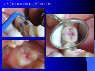  MÉTODOS COLORIMÉTRICOS

 