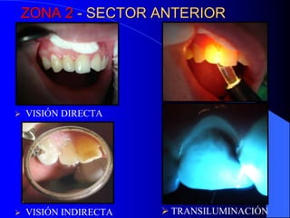 ZONA 2 - SECTOR ANTERIOR



VISIÓN DIRECTA



VISIÓN INDIRECTA

 TRANSILUMINACIÓN

 