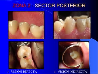 ZONA 2 - SECTOR POSTERIOR



VISIÓN DIRECTA



VISIÓN INDIRECTA

 