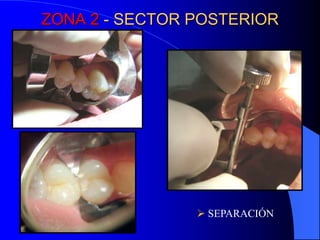 ZONA 2 - SECTOR POSTERIOR

 SEPARACIÓN

 