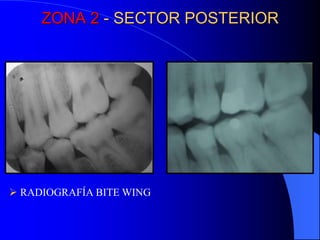 ZONA 2 - SECTOR POSTERIOR

 RADIOGRAFÍA BITE WING

 