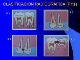 CLASIFICACIÓN RADIOGRÁFICA (Pitts)
R1

R4

R2

R5

 