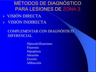 MÉTODOS DE DIAGNÓSTICO
PARA LESIONES DE ZONA 3



VISIÓN DIRECTA
VISIÓN INDIRECTA
COMPLEMENTAR CON DIAGNÓSTICO
DIFERENCIAL
Hipocalcificaciones
Fluorosis
Hipoplasia
Abrasión
Erosión
Abfracción

 