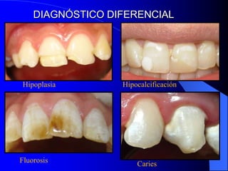 DIAGNÓSTICO DIFERENCIAL

Hipoplasia

Fluorosis

Hipocalcificación

Caries

 