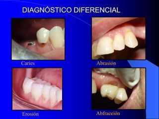 DIAGNÓSTICO DIFERENCIAL

Caries

Abrasión

Erosión

Abfracción

 