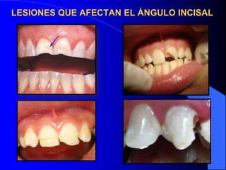 LESIONES QUE AFECTAN EL ÁNGULO INCISAL

 