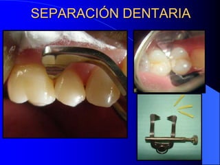 SEPARACIÓN DENTARIA

 