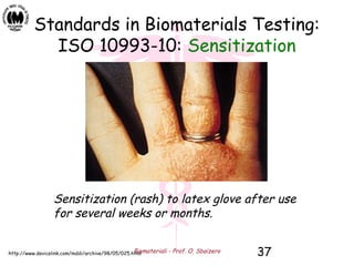 Biomateriali - Prof. O. Sbaizero 37
Standards in Biomaterials Testing:
ISO 10993-10: Sensitization
Sensitization (rash) to latex glove after use
for several weeks or months.
http://www.devicelink.com/mddi/archive/98/05/025.html
 