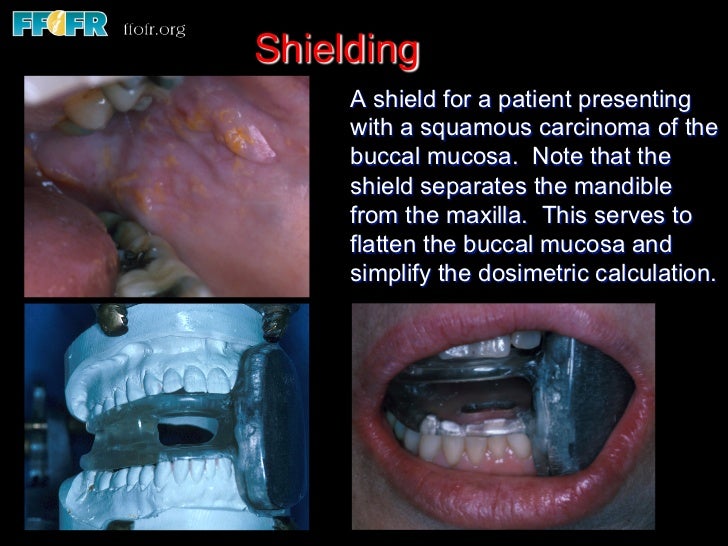 2.use of splints and stents during radiation therapy