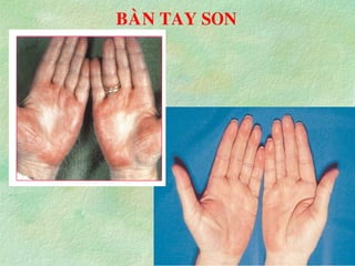 BAØN TAY SON
 