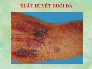 XUAÁT HUYEÁT DÖÔÙI DA
 