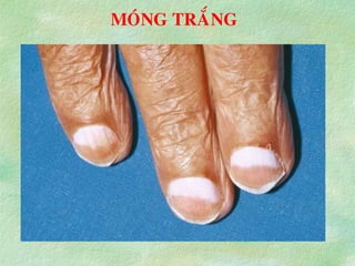 MOÙNG TRAÉNG
 