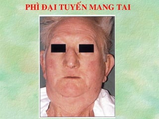 PHÌ ÑAÏI TUYEÁN MANG TAI
 
