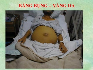 BAÙNG BUÏNG – VAØNG DA
 