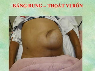 BAÙNG BUÏNG – THOAÙT VÒ ROÁN
 