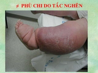 ≠ PHUØ CHI DO TAÉC NGHEÕN
 