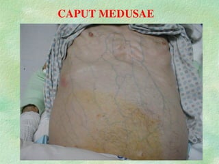 CAPUT MEDUSAE
 