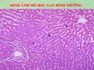 HÌNH AÛNH MOÂ HOÏC GAN BÌNH THÖÔØNG
 