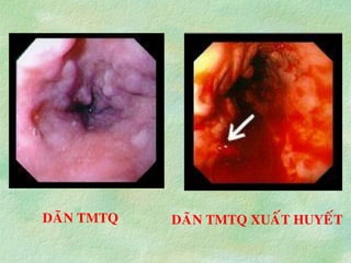 DAÕN TMTQ DAÕN TMTQ XUAÁT HUYEÁT
 