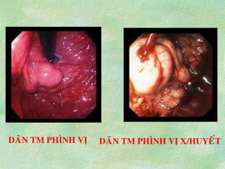 DAÕN TM PHÌNH VÒ DAÕN TM PHÌNH VÒ X/HUYEÁT
 