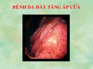 BEÄNH DAÏ DAØY TAÊNG AÙP CÖÛA
 