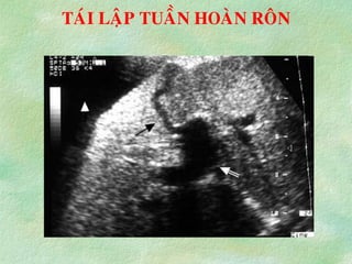 TAÙI LAÄP TUAÀN HOAØN ROÂN
 