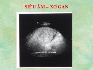 SIEÂU AÂM – XÔ GAN
 