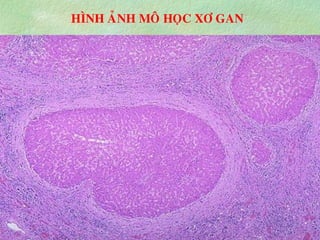 HÌNH AÛNH MOÂ HOÏC XÔ GAN
 