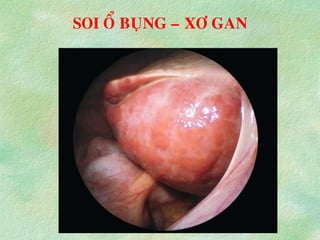 SOI OÅ BUÏNG – XÔ GAN
 