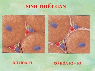 SINH THIEÁT GAN
XÔ HOÙA F1 XÔ HOÙA F2 – F3
 