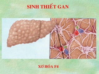 SINH THIEÁT GAN
XÔ HOÙA F4
 