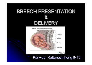 BREECH PRESENTATION
         &
     DELIVERY




     Panwad Rattanasrithong INT2
 