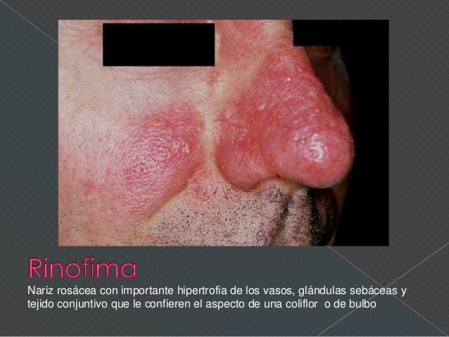 El modo bueno sanar el hongo de las uñas