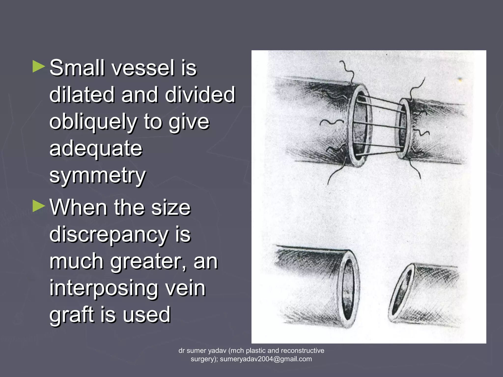 ►Small vessel isSmall vessel is
dilated and divideddilated and divided
obliquely to giveobliquely to give
adequateadequate
symmetrysymmetry
►When the sizeWhen the size
discrepancy isdiscrepancy is
much greater, anmuch greater, an
interposing veininterposing vein
graft is usedgraft is used
dr sumer yadav (mch plastic and reconstructive
surgery); sumeryadav2004@gmail.com
 