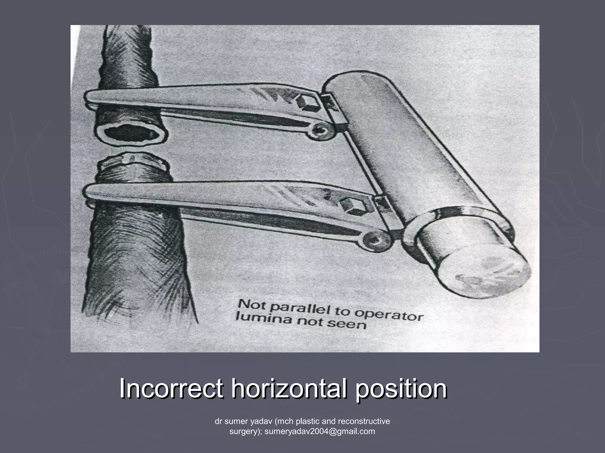 Incorrect horizontal positionIncorrect horizontal position
dr sumer yadav (mch plastic and reconstructive
surgery); sumeryadav2004@gmail.com
 