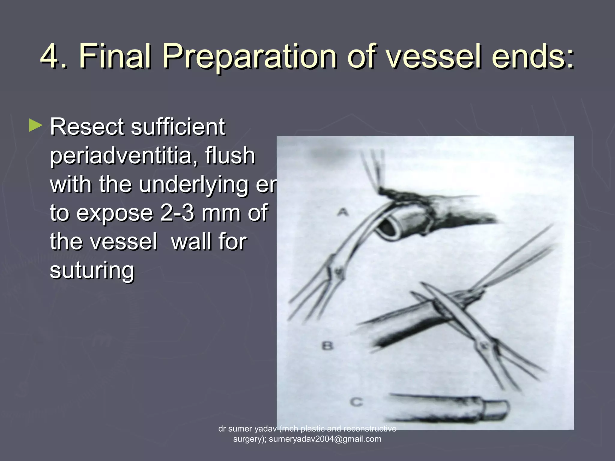 4. Final Preparation of vessel ends:4. Final Preparation of vessel ends:
► Resect sufficientResect sufficient
periadventitia, flushperiadventitia, flush
with the underlying endwith the underlying end
to expose 2-3 mm ofto expose 2-3 mm of
the vessel wall forthe vessel wall for
suturingsuturing
dr sumer yadav (mch plastic and reconstructive
surgery); sumeryadav2004@gmail.com
 