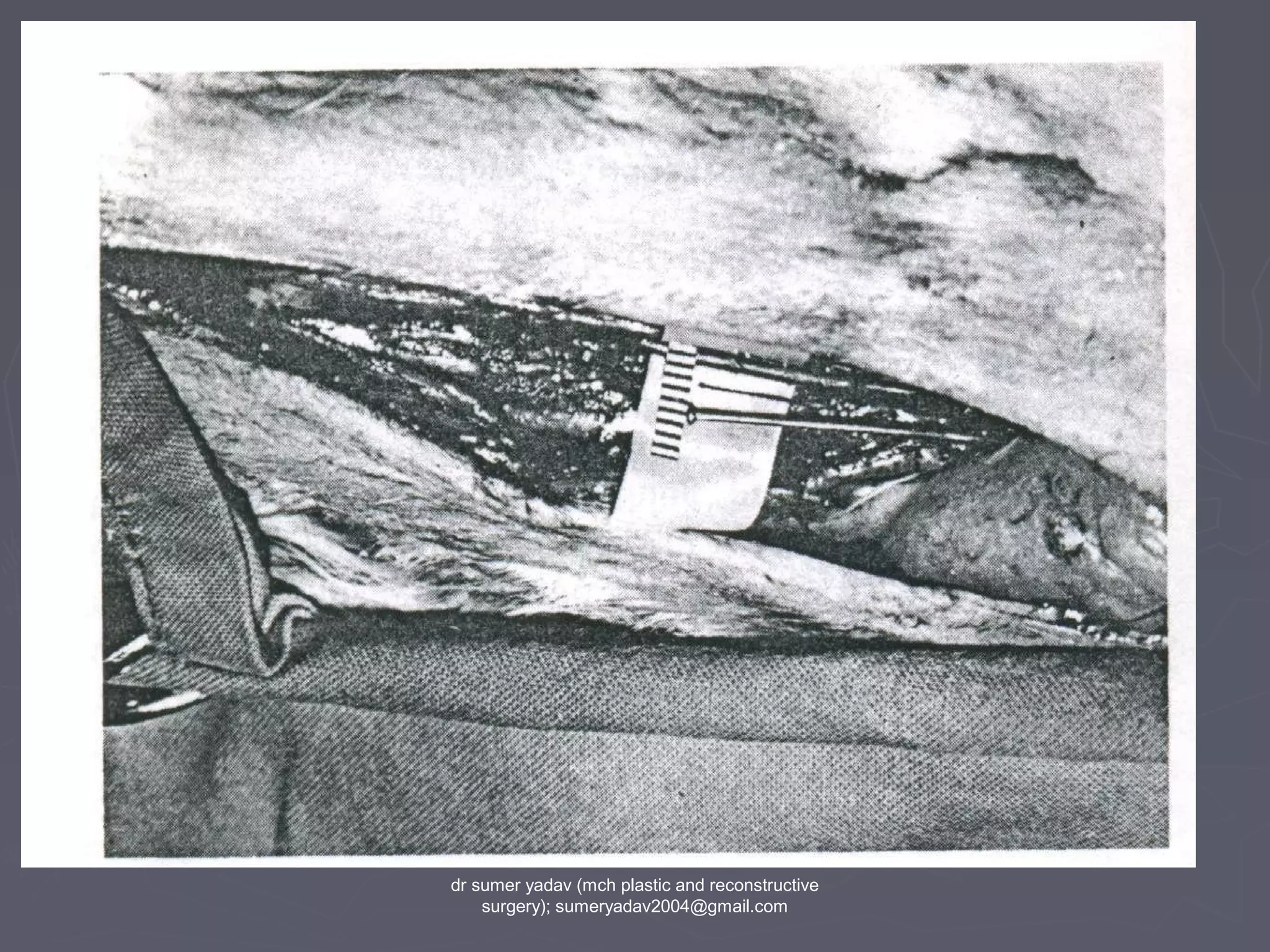 dr sumer yadav (mch plastic and reconstructive
surgery); sumeryadav2004@gmail.com
 