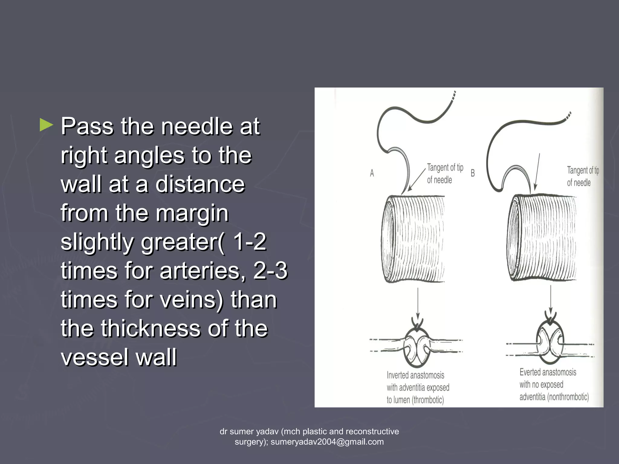 ► Pass the needle atPass the needle at
right angles to theright angles to the
wall at a distancewall at a distance
from the marginfrom the margin
slightly greater( 1-2slightly greater( 1-2
times for arteries, 2-3times for arteries, 2-3
times for veins) thantimes for veins) than
the thickness of thethe thickness of the
vessel wallvessel wall
dr sumer yadav (mch plastic and reconstructive
surgery); sumeryadav2004@gmail.com
 