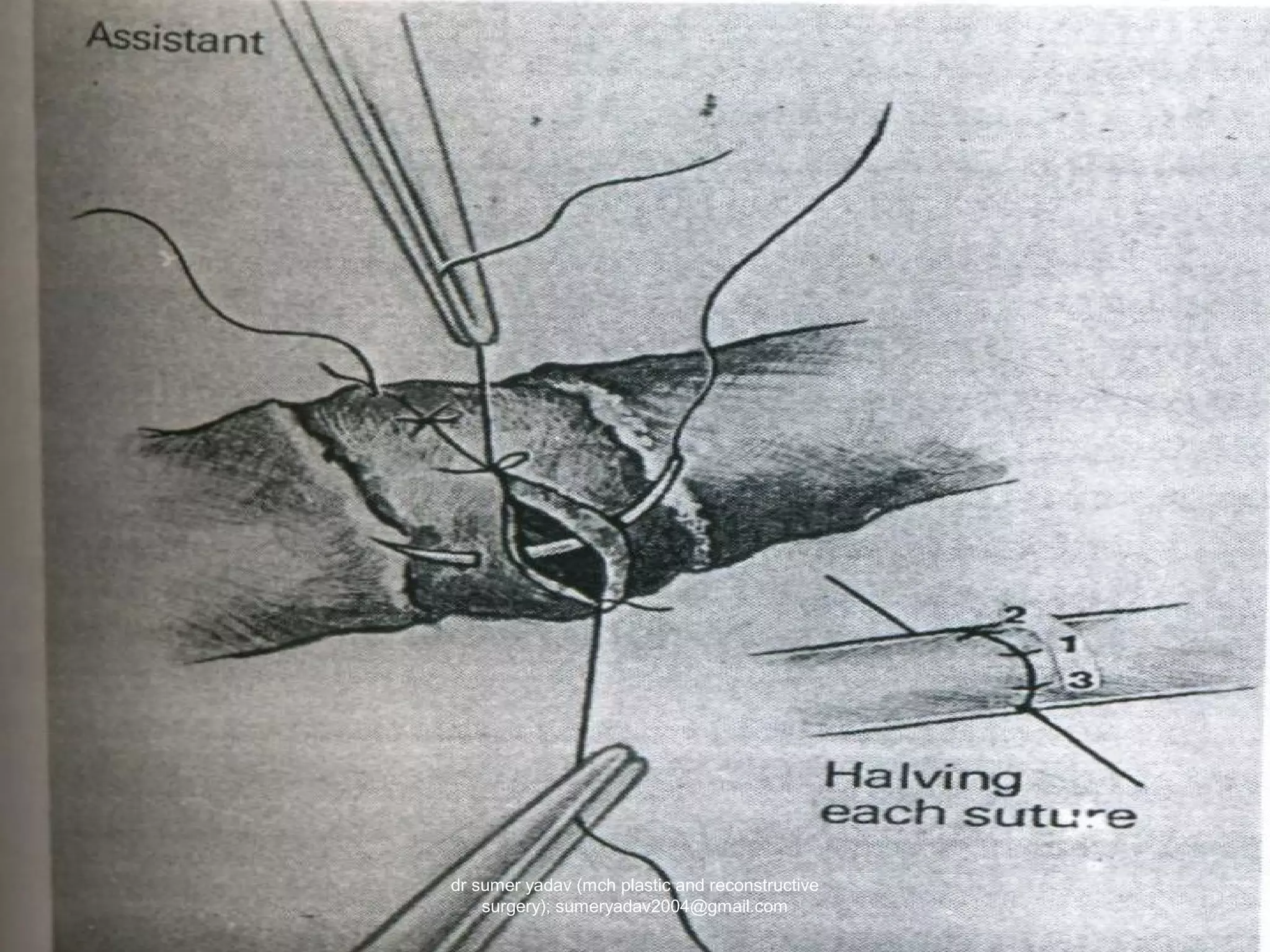 dr sumer yadav (mch plastic and reconstructive
surgery); sumeryadav2004@gmail.com
 