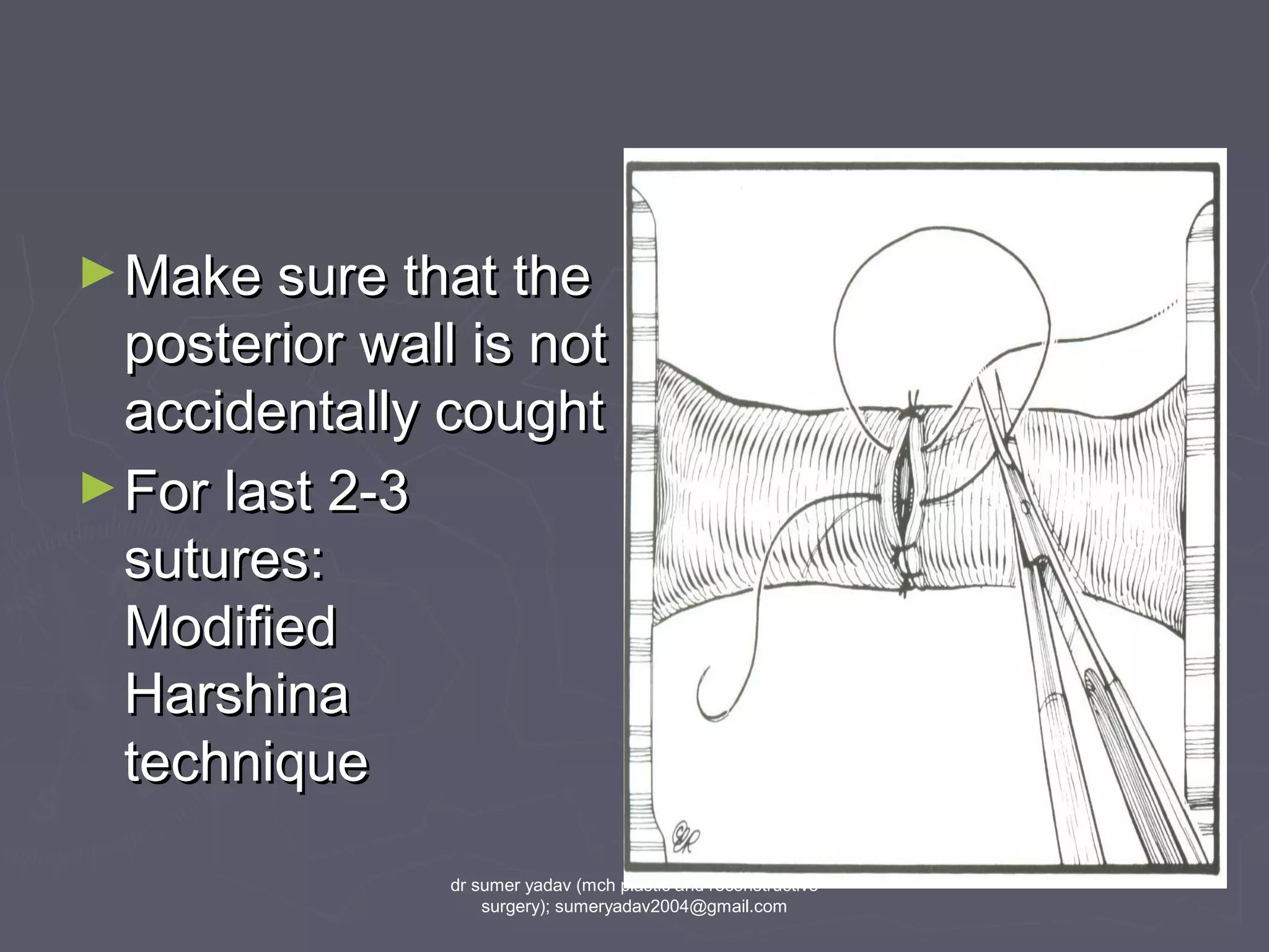 ►Make sure that theMake sure that the
posterior wall is notposterior wall is not
accidentally coughtaccidentally cought
►For last 2-3For last 2-3
sutures:sutures:
ModifiedModified
HarshinaHarshina
techniquetechnique
dr sumer yadav (mch plastic and reconstructive
surgery); sumeryadav2004@gmail.com
 