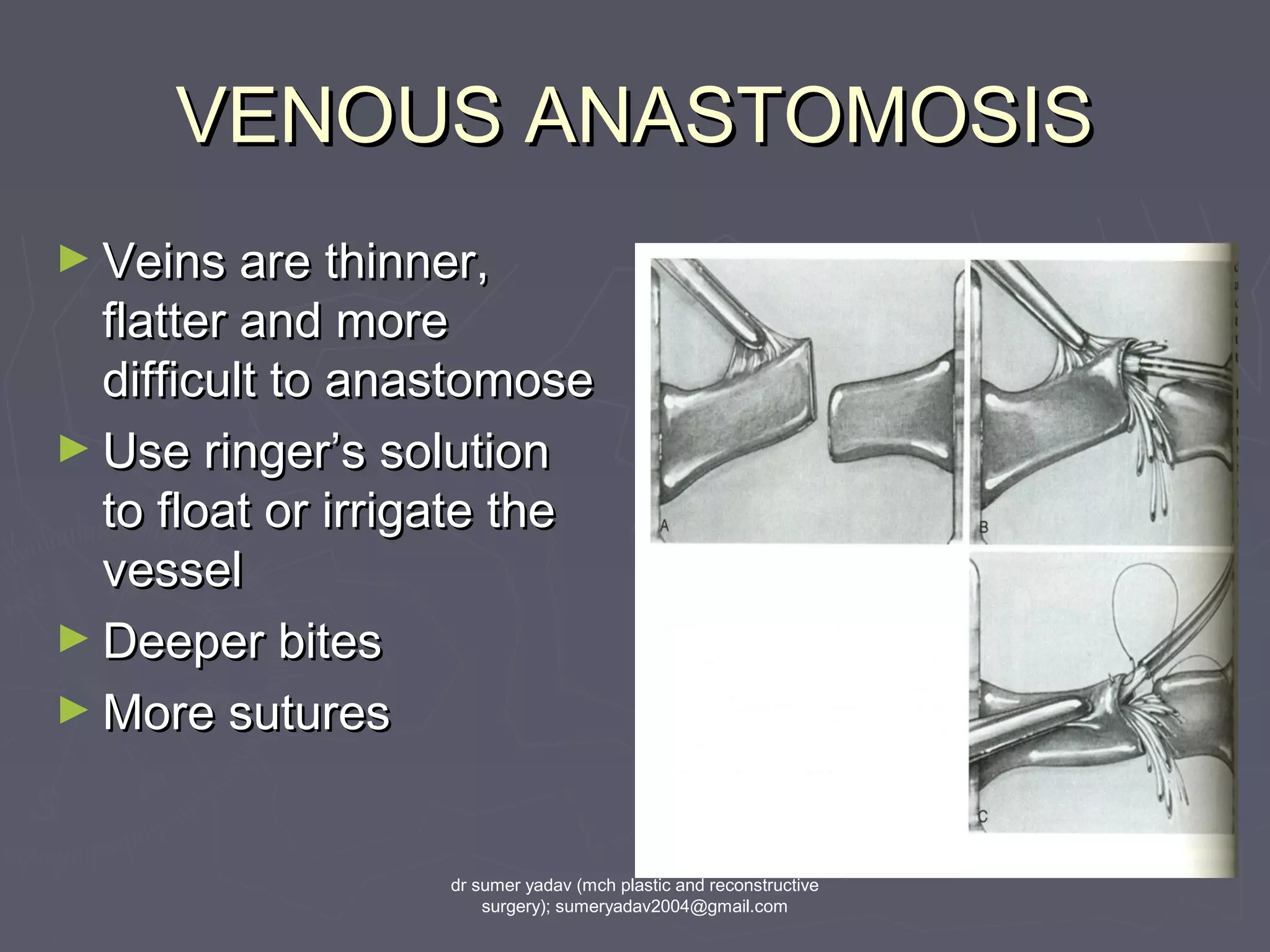 VENOUS ANASTOMOSISVENOUS ANASTOMOSIS
► Veins are thinner,Veins are thinner,
flatter and moreflatter and more
difficult to anastomosedifficult to anastomose
► Use ringer’s solutionUse ringer’s solution
to float or irrigate theto float or irrigate the
vesselvessel
► Deeper bitesDeeper bites
► More suturesMore sutures
dr sumer yadav (mch plastic and reconstructive
surgery); sumeryadav2004@gmail.com
 