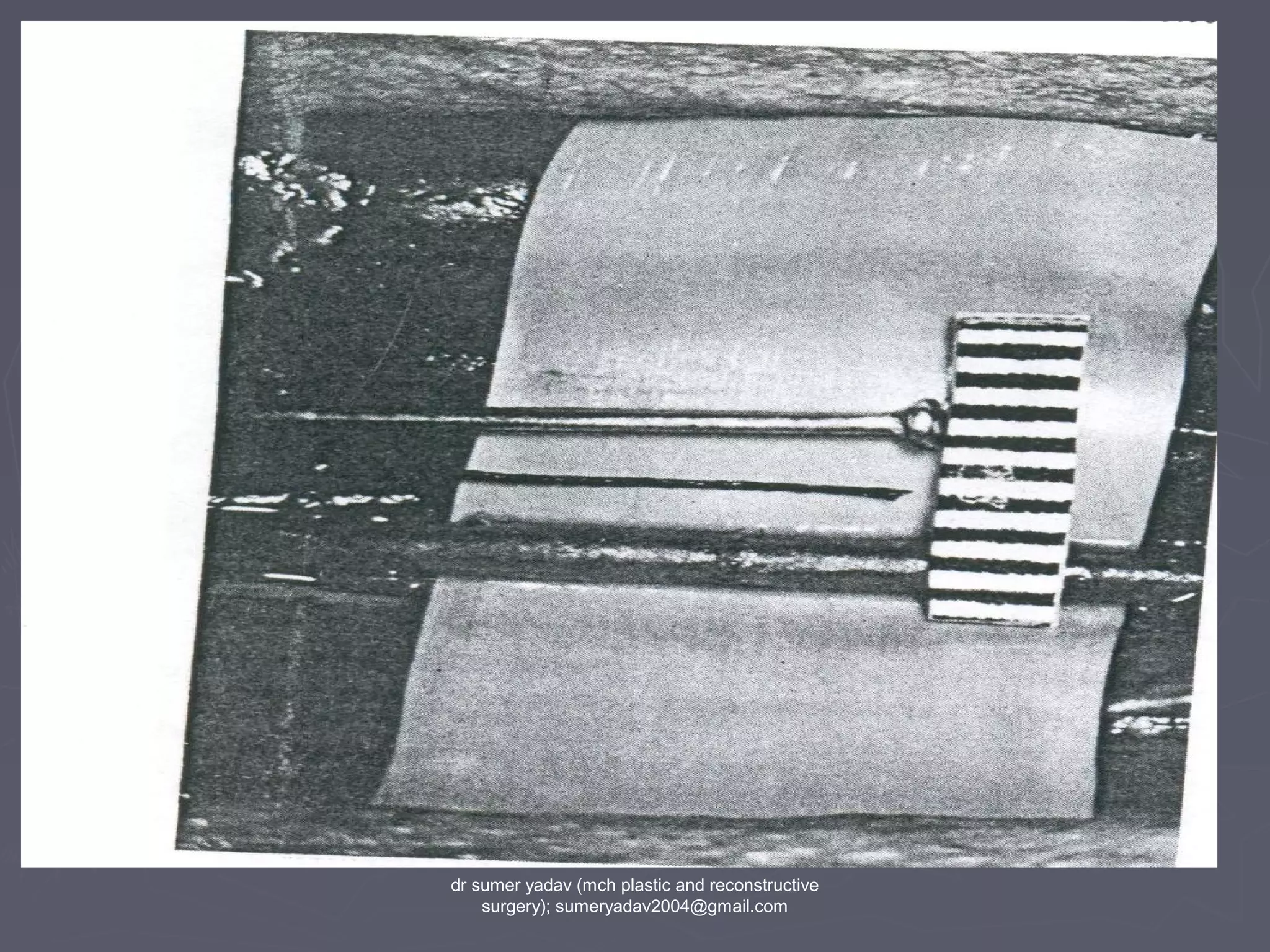 dr sumer yadav (mch plastic and reconstructive
surgery); sumeryadav2004@gmail.com
 