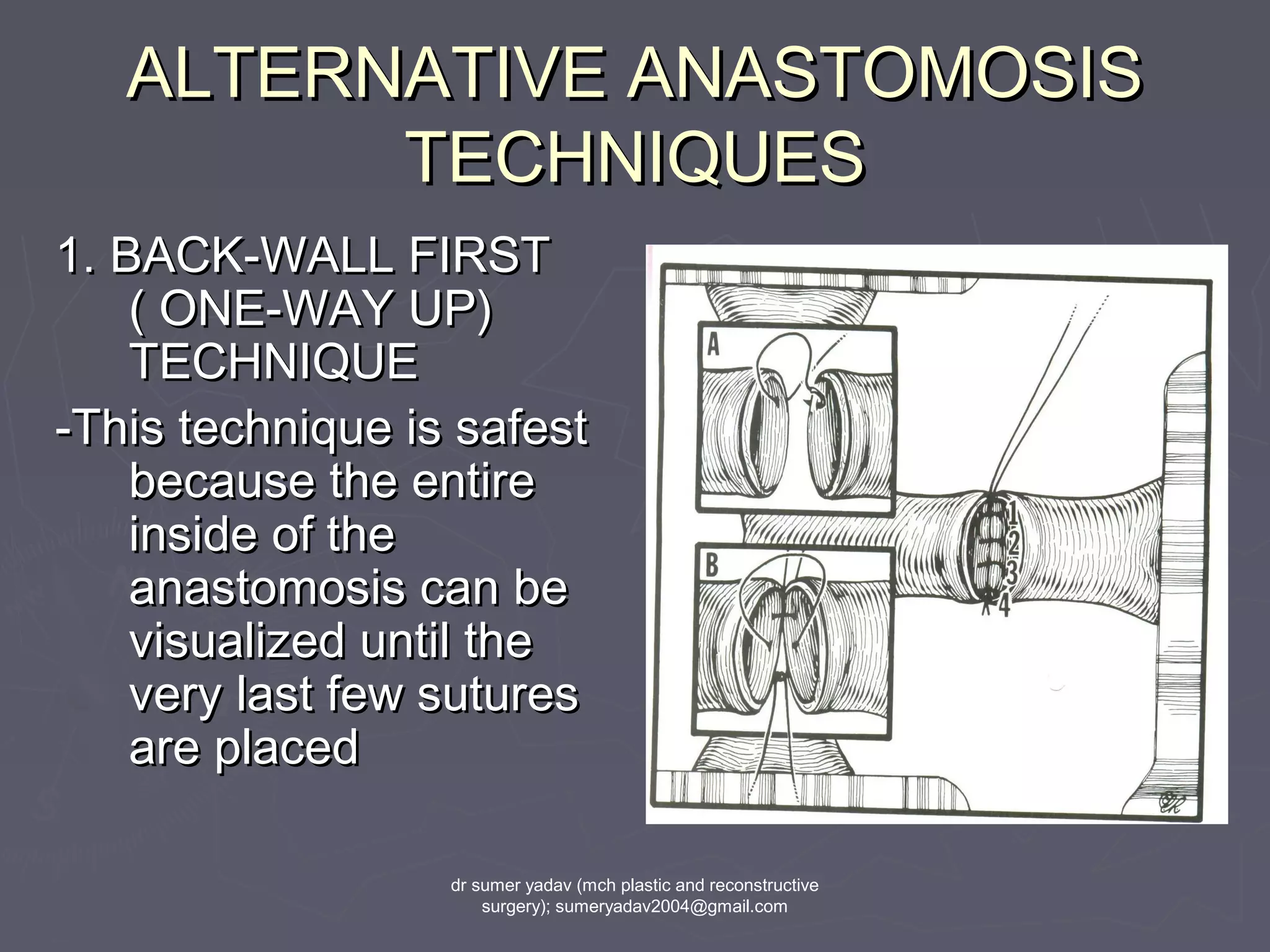 ALTERNATIVE ANASTOMOSISALTERNATIVE ANASTOMOSIS
TECHNIQUESTECHNIQUES
1. BACK-WALL FIRST1. BACK-WALL FIRST
( ONE-WAY UP)( ONE-WAY UP)
TECHNIQUETECHNIQUE
-This technique is safest-This technique is safest
because the entirebecause the entire
inside of theinside of the
anastomosis can beanastomosis can be
visualized until thevisualized until the
very last few suturesvery last few sutures
are placedare placed
dr sumer yadav (mch plastic and reconstructive
surgery); sumeryadav2004@gmail.com
 